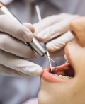 Usuwanie zębów w upał – co warto wiedzieć?